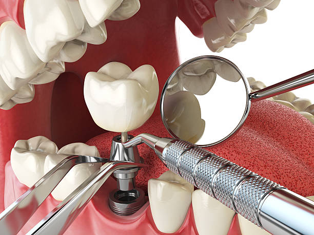 Best Emergency Root Canal Treatment in La Conner, WA